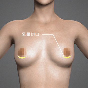 腋下切口台灣最受歡迎的切口位置